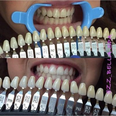 DaVinci Teeth Whitening Service. A ten shade improvement in only three sessions.