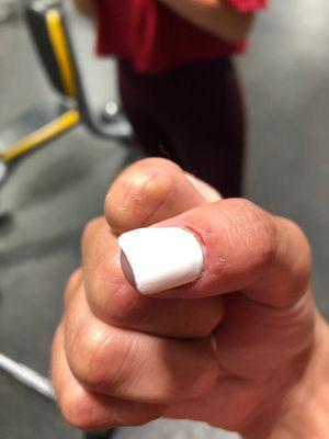 Injury from the electric buffer