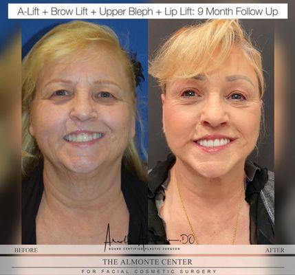 B/A: A-Lift + Brow Lift + Upper Bleph + Lip Lift