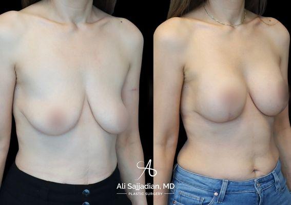 Before and After | Breast Augmentation and Lift