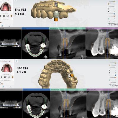 Surgically guided implant planning