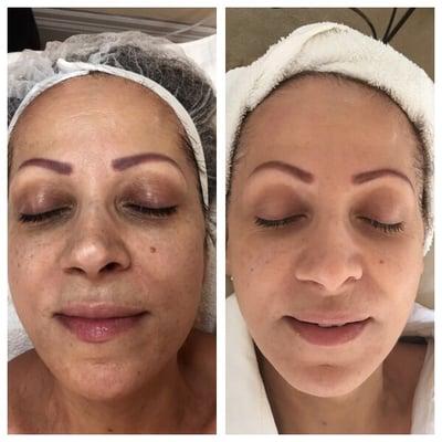 Microneedling, session 4