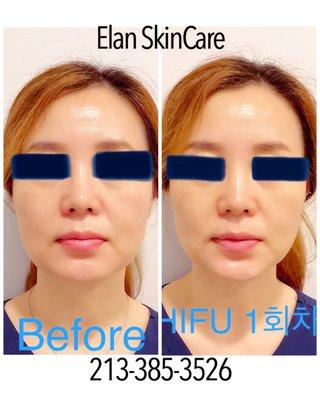 After the first HIFU treatment, my face underwent a remarkable transformation