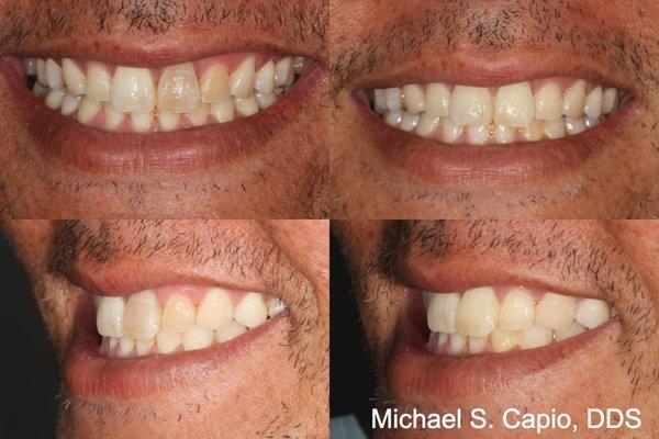 Internal bleaching was done to make 2 dark teeth match the others!