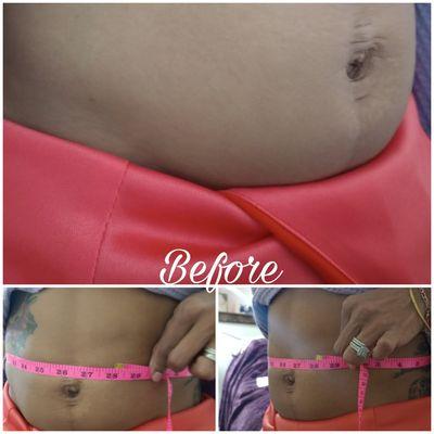 Slimmer Waist Sculpting Treatment Before