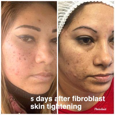 Plasma fibroblasts treatment can enchanted your skin booking at Gianna's beauty salon in port Charlotte fl...