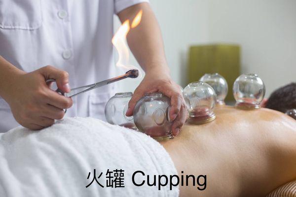 Cupping