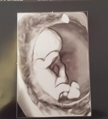 3d pic at 10 weeks