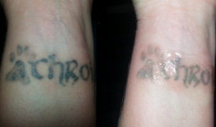 Tattoo Removal