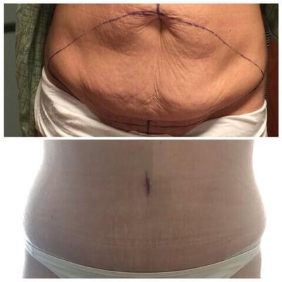 Top pic (my before tummy tuck)                         Bottom pic (7 weeks post tummy tuck)