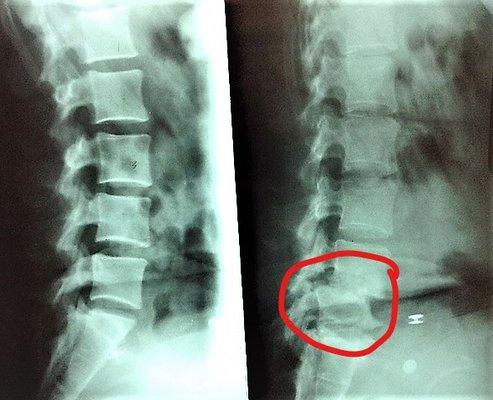 This person dealt with back pain for years until it became so severe.  Unfortunately he had to have surgery!