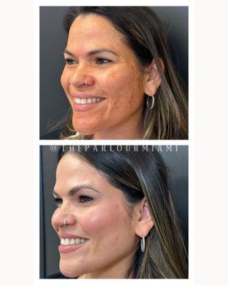 Botox with VI Peel