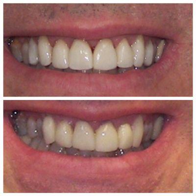 Porcelain Veneers.