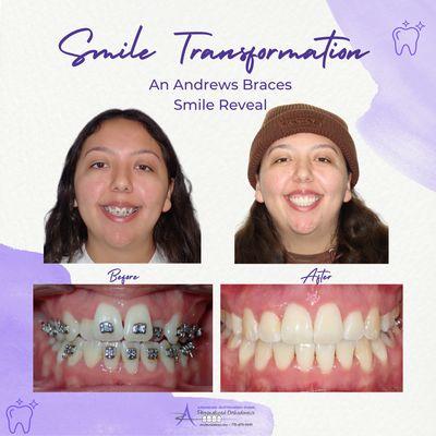 An Andrews Braces Smile Transformation