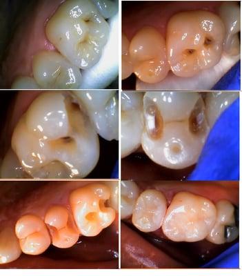 Cavity can be chalky white, brown, or black. It will keep penetrating the tooth if left untreated.