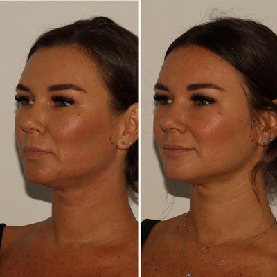 Low Face and Neck Rejuvenation