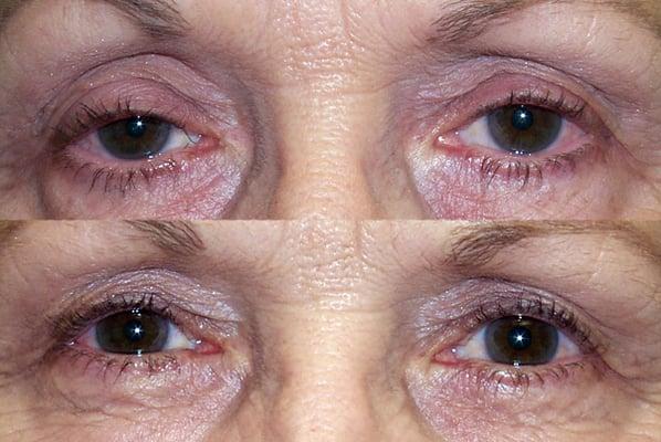 Before and After Upper eyelid ptosis (droopy eyelid surgery)
 www.DrMarkBrown.com 
 Mobile, AL 36609
 251-650-5437