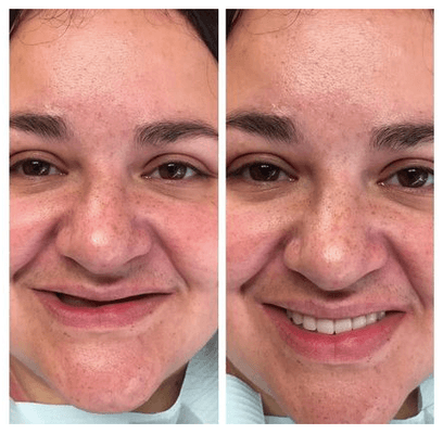 Before and After at NÜVA Smile | Clifton, NJ