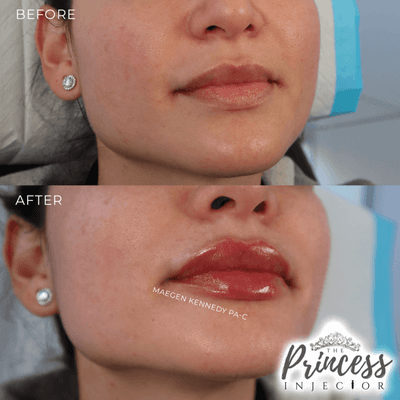 PA Maegen Kennedy's Signature MK Pout - Lip Filler Orlando FL