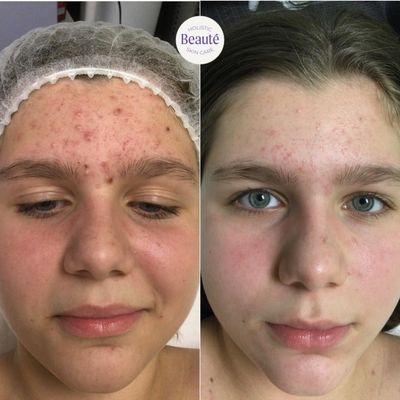 Acne, 3 month after