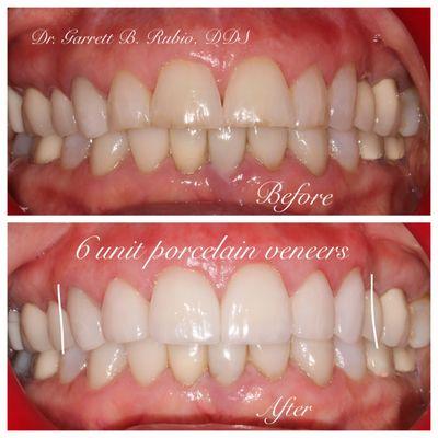 All it took was 6 conservative porcelain veneers to brighten up this smile!