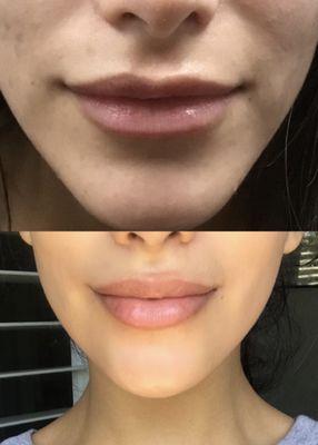 As I stated in my review, Dr. Black is amazing. Top is before my lip injections and bottom is after.  (This is without any makeup too!)