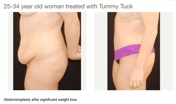 Tummy Tuck :)