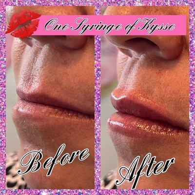 Lip Fillers