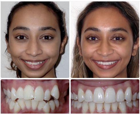 Invisalign treatment with removal of 4 premolars