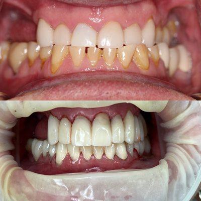 The process of smile change, large cases such as this we will place beautiful temps to allow for a trial bite and smile!