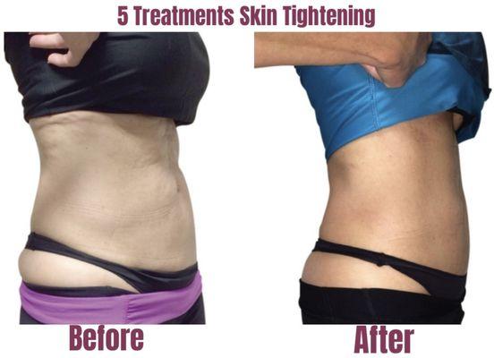 New waistline, toned abs, and firm midsection! Skin tightening, just 5 treatments!!