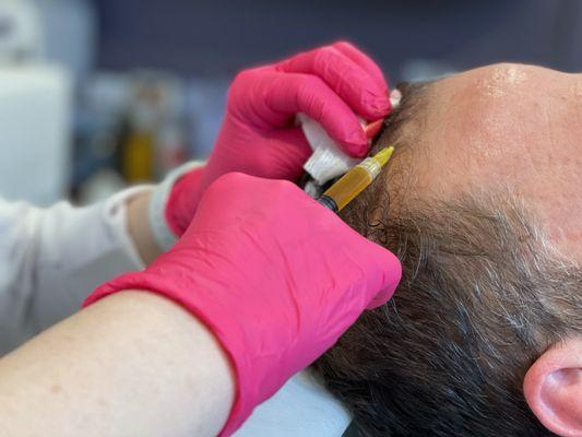 PRFM Scalp - Hair Restoration