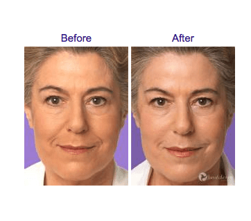 Juvederm