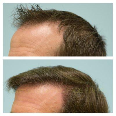 This 48-year-old man is shown before and 10 months after a hair transplant into his frontal scalp/midscalp,crown, and temporal/parietal area