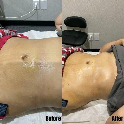 Before and after 1 session of lymphatic drainage.