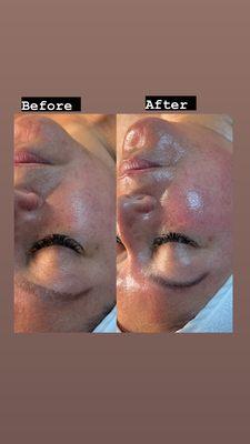 C-peptide with microdermabrasion. Anti Aging treatment