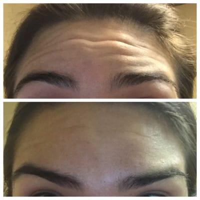 Top is before and bottom is 2 days after. This is with Botox and I can tell you my last few lines softened even more since then.