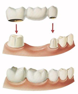 A bridge is a fixed dental restoration used to replace a missing tooth by joining an artificial tooth permanently to adjacent teeth.