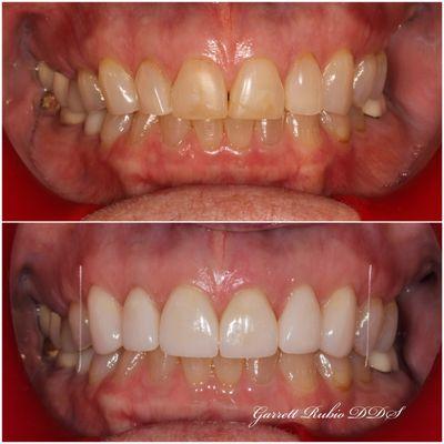 6 beautiful porcelain veneers to restore brightness to this now memorable smile!