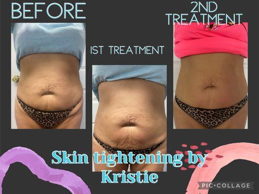 Radio Frequency Skin Tightening