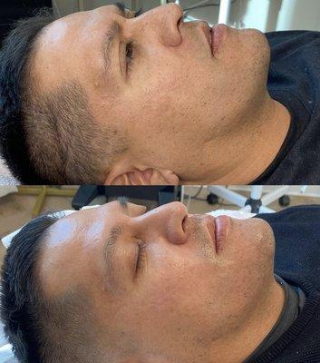 Microneeding has improved this client's texture, minimized his pores and brightened his tone!