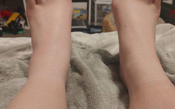 My left foot, as you can see, is swollen on the side where I nearly snapped it in half.