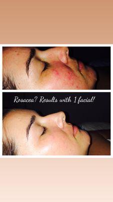 Rosacea Facial before and after