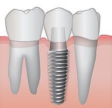 Renew Dental Implants Specialists