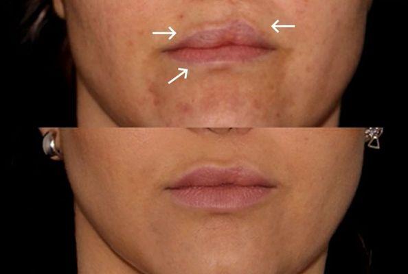 cleft lip treatment very simple fibroblasting treatment no down time.