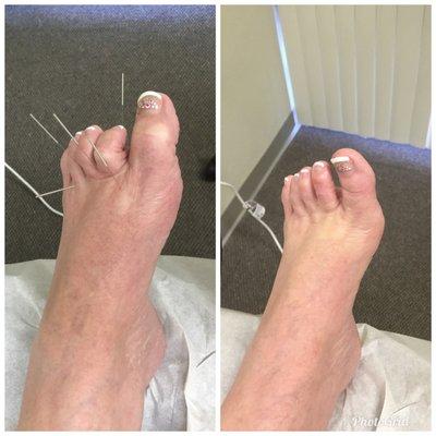 Before and after acupuncture treatment