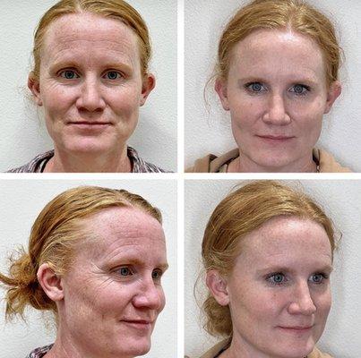 Botox Transformation