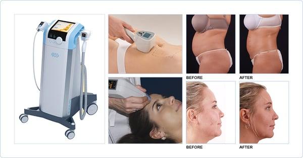 Exilis offers Body Shaping & Skin Tightening!