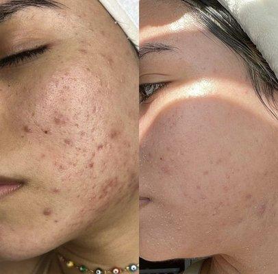 Advance acne and discoloration treatment