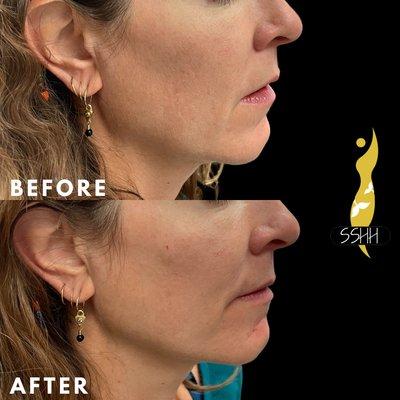 Filler in the cheeks and chin by Dr. Stefanie Maass.